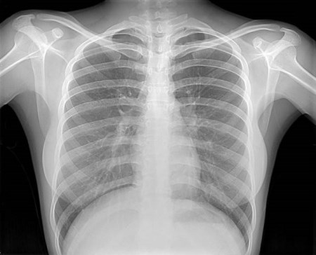  Рентген грудной клетки